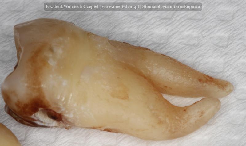 Liczba kanałów w zębie ósemce