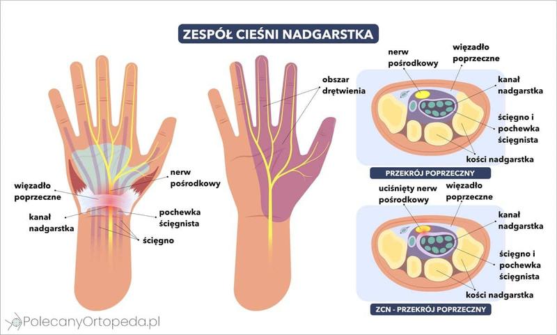 Objawy zespołu cieśni kanału nadgarstka