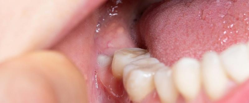 Różnice etniczne w budowie zębów ósemek