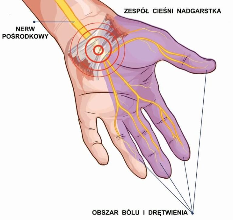Kiedy pojawiają się objawy zespołu cieśni kanału nadgarstka?