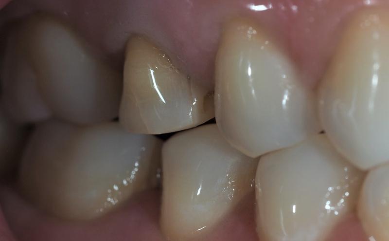 Piątka górna – jak wiele kanałów oferuje?